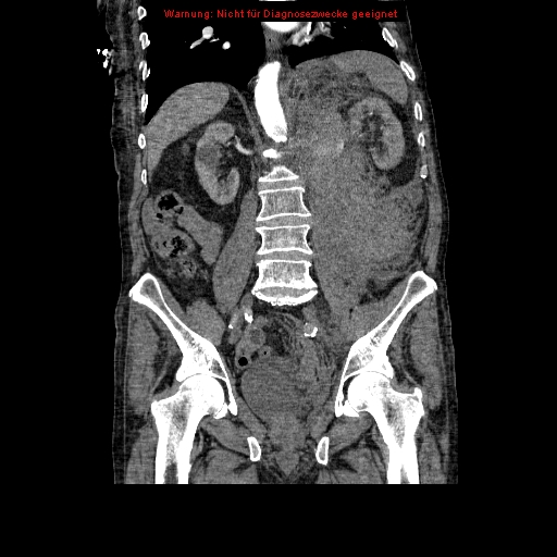 Abdominal aortic aneurysm- extremely large, ruptured (Radiopaedia 19882-19921 Coronal C+ arterial phase 63).jpg