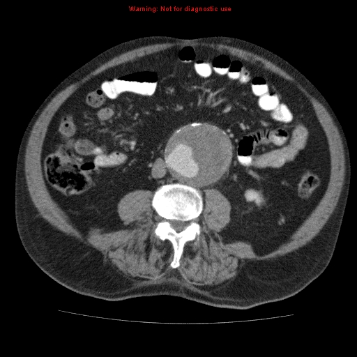 Abdominal aortic aneurysm (Radiopaedia 10122-10660 Axial C+ portal venous phase 45).jpg