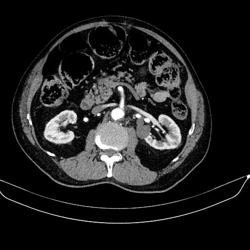Abdominal aortic aneurysm (Radiopaedia 67117-76452 Axial C+ arterial phase 58).jpg