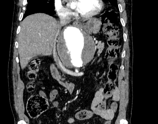 File:Abdominal aortic aneurysm (Radiopaedia 67117-76452 Coronal C+ arterial phase 40).jpg
