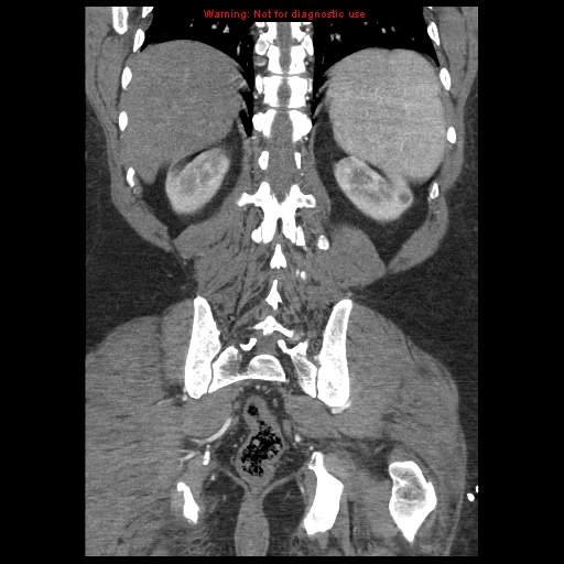 Abdominal aortic aneurysm (Radiopaedia 8190-9038 Coronal C+ arterial phase 100).jpg