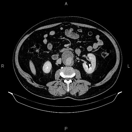 Abdominal aortic aneurysm (Radiopaedia 83094-97462 Axial renal excretory phase 49).jpg
