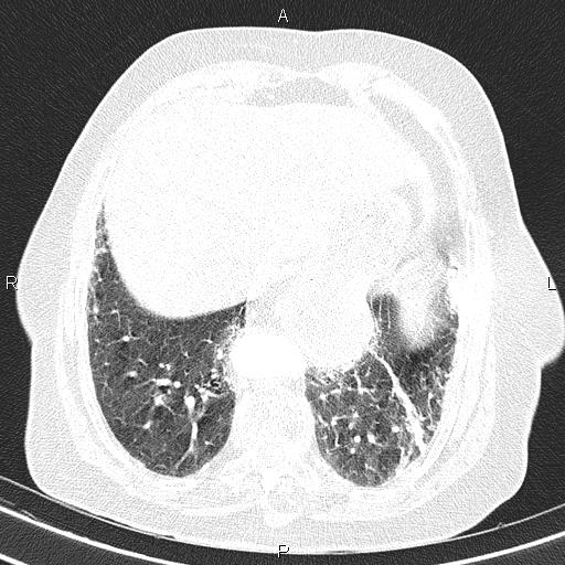 Abdominal aortic aneurysm (Radiopaedia 85063-100606 Axial lung window 51).jpg
