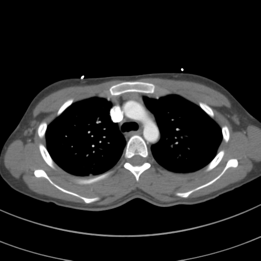 File:Abdominal multi-trauma - devascularised kidney and liver, spleen and pancreatic lacerations (Radiopaedia 34984-36486 Axial C+ arterial phase 27).png