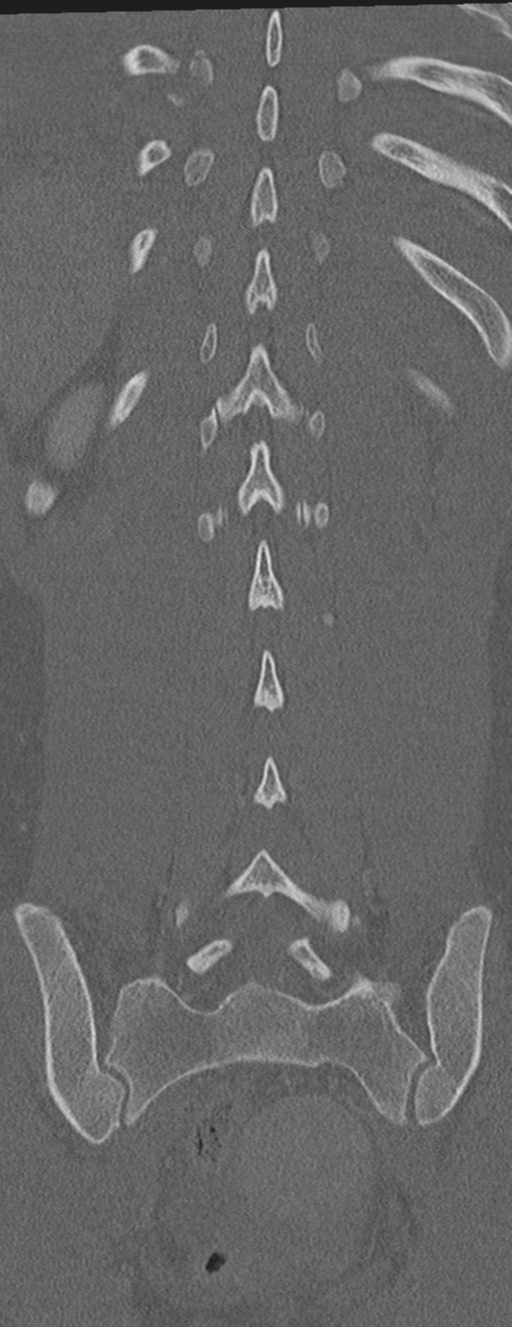 Abdominal multi-trauma - devascularised kidney and liver, spleen and pancreatic lacerations (Radiopaedia 34984-36486 Coronal bone window 53).png