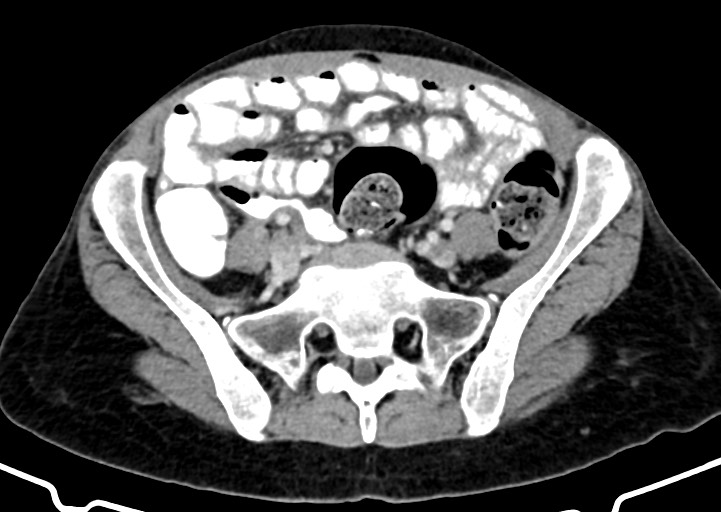 Abdominal wall and retroperitoneal tuberculosis (Radiopaedia 88137-104729 Axial C+ portal venous phase 135).jpg