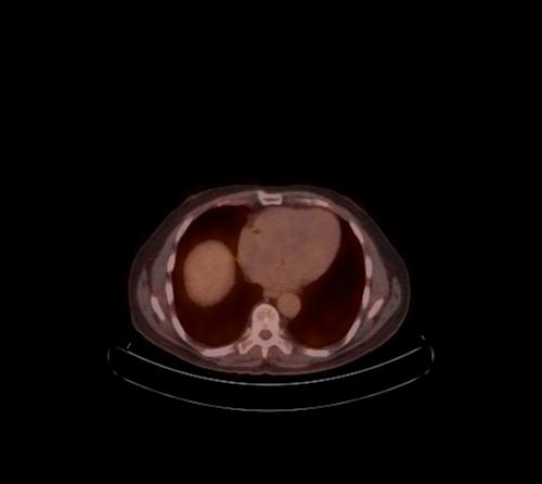 Abdominal wall metastasis from colorectal carcinoma (Radiopaedia 31016-31719 C 98).jpg