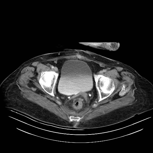 File:Abdominal wall recurrence after colorectal resection for cancer (Radiopaedia 23444-23523 Axial C+ portal venous phase 36).jpg