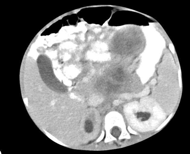 Abdominopelvic rhabdomyosarcoma (Radiopaedia 78356-90984 Axial C+ portal venous phase 66).jpg