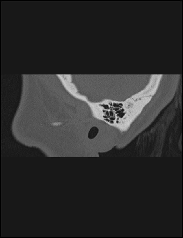 Aberrant right internal carotid artery (Radiopaedia 65191-74198 Sagittal non-contrast 12).jpg