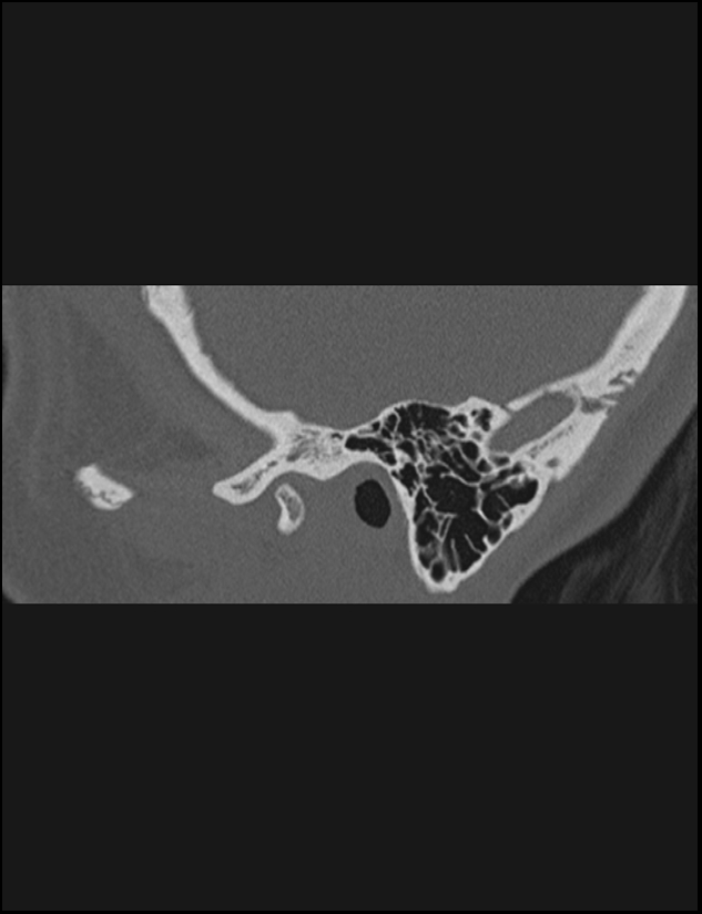 Aberrant right internal carotid artery (Radiopaedia 65191-74198 Sagittal non-contrast 22).jpg