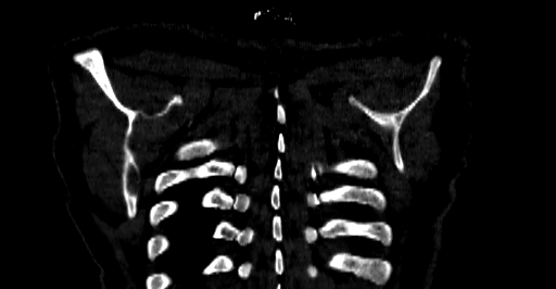 File:Accesory rib joint (Radiopaedia 71987-82452 Coronal bone window 84).jpg