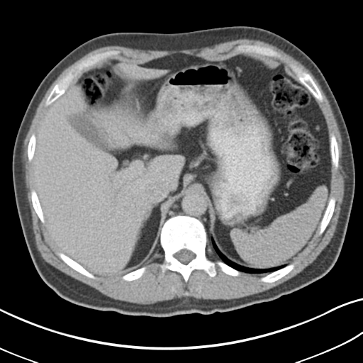 Achalasia of the cardia (Radiopaedia 38497-40595 Axial C+ portal venous phase 20).png