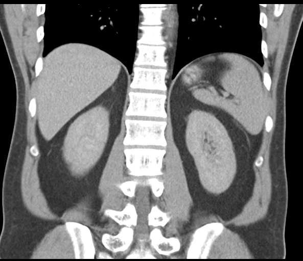 File:Achalasia of the cardia (Radiopaedia 38497-40595 Coronal C+ portal venous phase 37).png