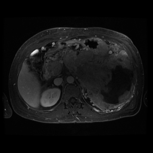 Acinar cell carcinoma of the pancreas (Radiopaedia 75442-86668 D 65).jpg