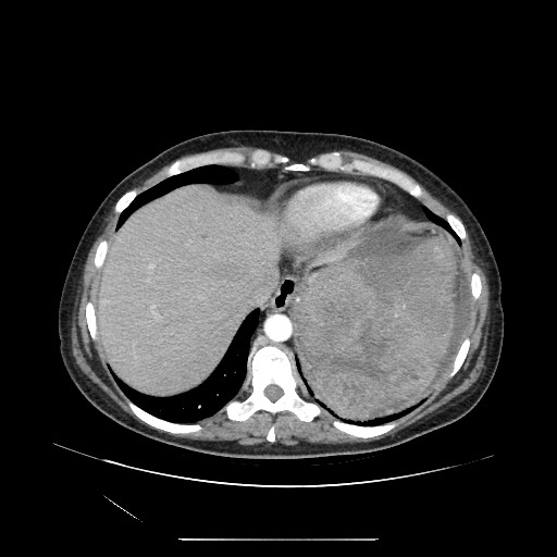 Acinar cell carcinoma of the pancreas (Radiopaedia 75442-86669 Axial C+ portal venous phase 16).jpg