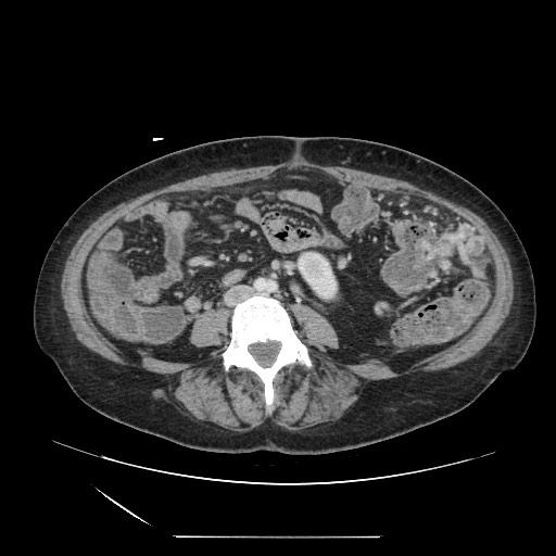 Acinar cell carcinoma of the pancreas (Radiopaedia 75442-86669 Axial C+ portal venous phase 87).jpg