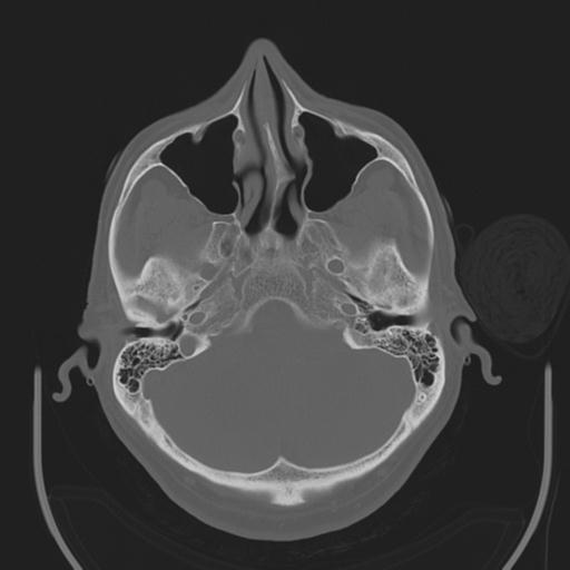 File:Acoustic schwannoma (Radiopaedia 29488-29982 AXIAL BONE THICK non-contrast 10).jpg