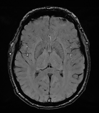 File:Acoustic schwannoma (Radiopaedia 50846-56358 Axial SWI 49).png