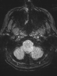 Acoustic schwannoma (Radiopaedia 55729-62281 Axial SWI 4).png