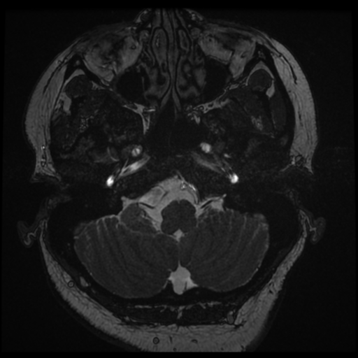 Acoustic schwannoma (Radiopaedia 57574-64536 Axial T2 10).png