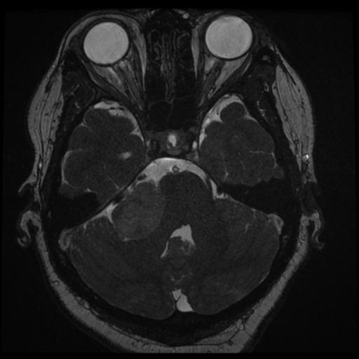 Acoustic schwannoma (Radiopaedia 57574-64536 Axial T2 48).png
