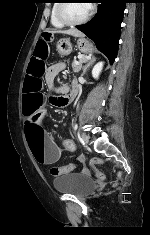 Active Crohn disease (Radiopaedia 59394-66750 Sagittal C+ portal venous phase 23).jpg