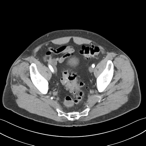 File:Active diverticular hemorrhage (Radiopaedia 39415-41725 Axial C+ arterial phase 58).png