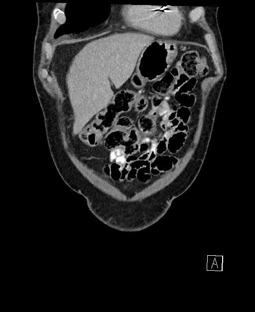Active lower gastrointestinal bleeding - diverticular (Radiopaedia 61203-69106 Coronal C+ portal venous phase 24).jpg