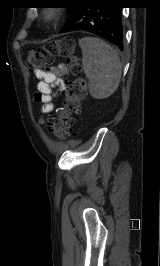 Active lower gastrointestinal bleeding - diverticular (Radiopaedia 61203-69106 Sagittal C+ arterial phase 24).jpg