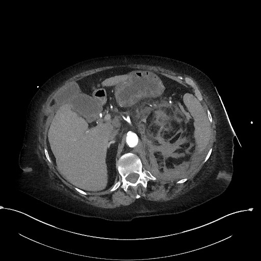 Active renal extravasation with large subcapsular and retroperitoneal hemorrhage (Radiopaedia 60975-68796 Axial C+ arterial phase 59).jpg