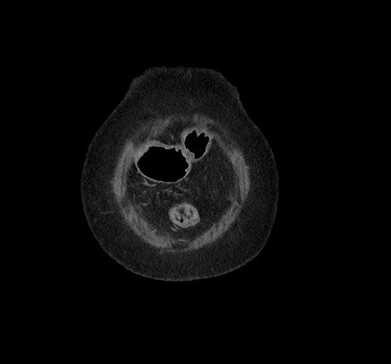 Active renal extravasation with large subcapsular and retroperitoneal hemorrhage (Radiopaedia 60975-68796 Coronal C+ portal venous phase 19).jpg