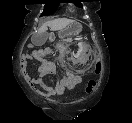 File:Active renal extravasation with large subcapsular and retroperitoneal hemorrhage (Radiopaedia 60975-68796 Coronal C+ portal venous phase 48).jpg