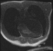 File:Active right ventricular cardiac sarcoidosis (Radiopaedia 55596-62100 Axial Dynamic perfusion scan MOCO 24).jpg