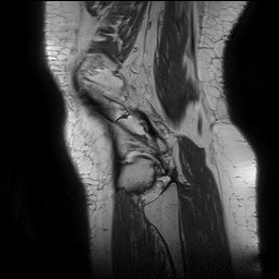 Acute-on-chronic transient lateral patellar dislocation with trochlear dysplasia (Radiopaedia 84099-99349 Sagittal PD 138).jpg