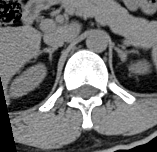 File:Acute L1 burst compression fracture (Radiopaedia 34430-35755 Axial non-contrast 3).png