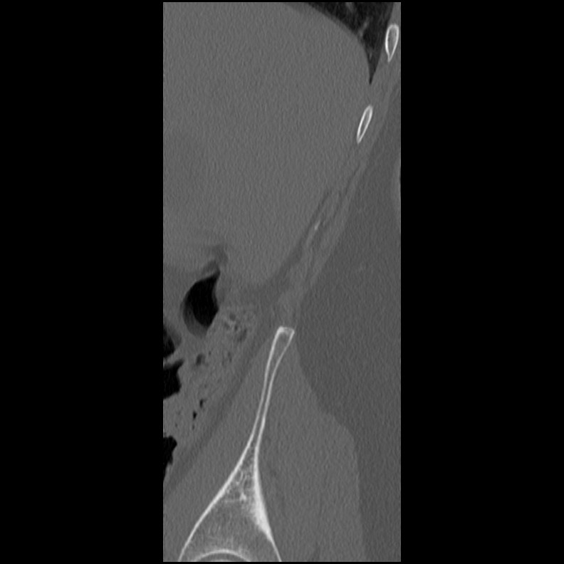 Acute Schmorl's node (Radiopaedia 83276-102365 Sagittal bone window 81).jpg