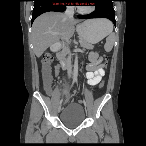File:Acute appendicitis (Radiopaedia 10498-10973 F 17).jpg