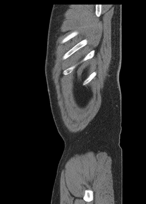 Acute appendicitis (Radiopaedia 48511-53463 Sagittal C+ portal venous phase 122).jpg