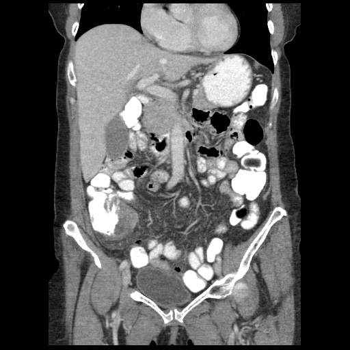 File:Acute appendicitis (Radiopaedia 52672-58589 Coronal 1).jpg
