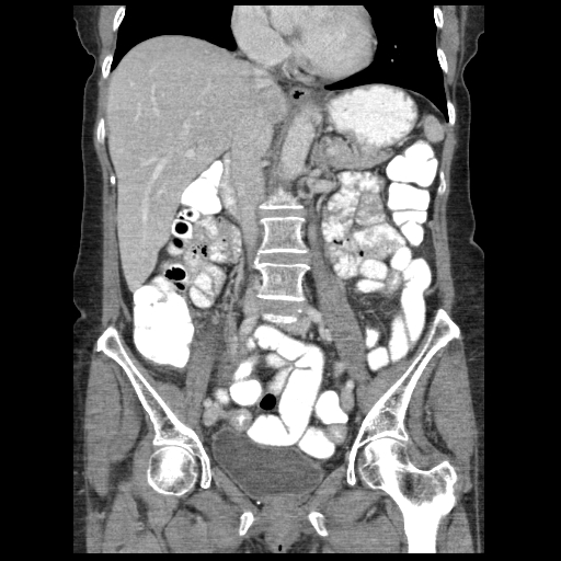 Acute appendicitis (Radiopaedia 52672-58589 Coronal C+ portal venous phase 55).jpg
