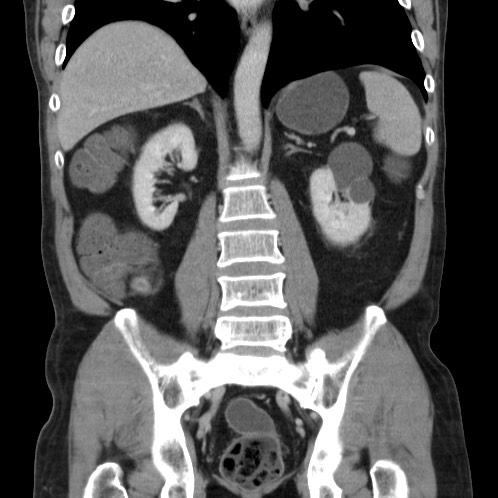 Acute appendicitis (Radiopaedia 66513-75790 Coronal C+ portal venous phase 56).jpg