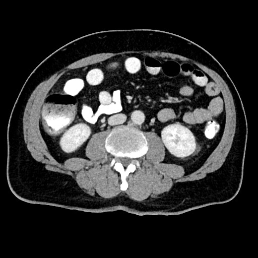 Acute appendicitis (Radiopaedia 77016-88960 Axial C+ portal venous phase 74).jpg