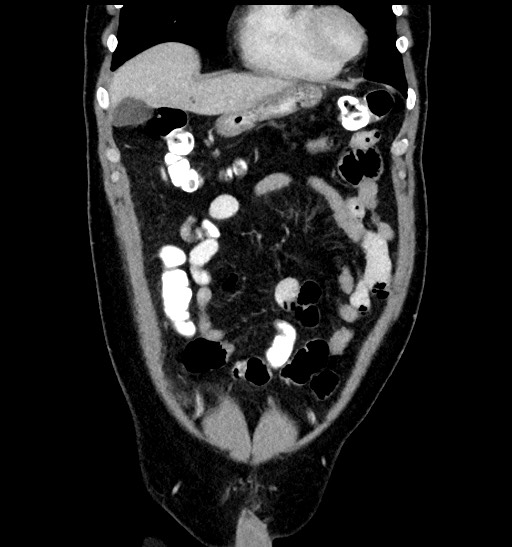 Acute appendicitis (Radiopaedia 77016-88960 Coronal C+ portal venous phase 31).jpg