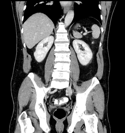 Acute appendicitis (Radiopaedia 77016-88960 Coronal C+ portal venous phase 65).jpg