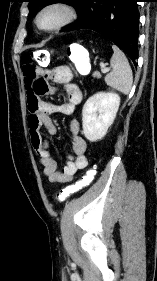 Acute appendicitis (Radiopaedia 77016-88960 Sagittal C+ portal venous phase 28).jpg