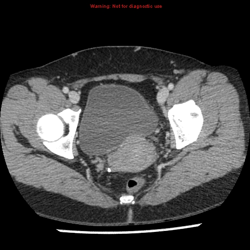File:Acute appendicitis (Radiopaedia 7966-8812 C+ portal venous phase 51).jpg