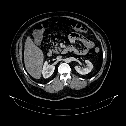 Acute appendicitis (Radiopaedia 79950-93224 Axial C+ portal venous phase 41).jpg