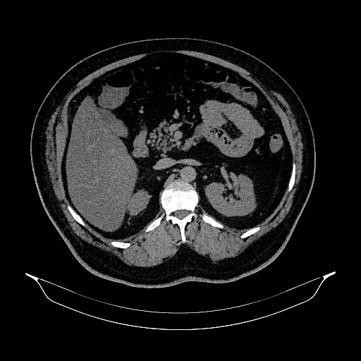 File:Acute appendicitis (Radiopaedia 79950-93224 Axial non-contrast 37).jpg
