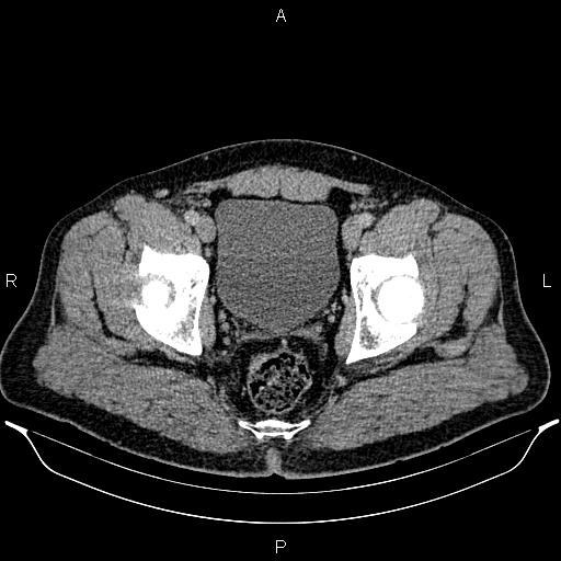 Acute appendicitis (Radiopaedia 84780-100240 Axial C+ portal venous phase 101).jpg